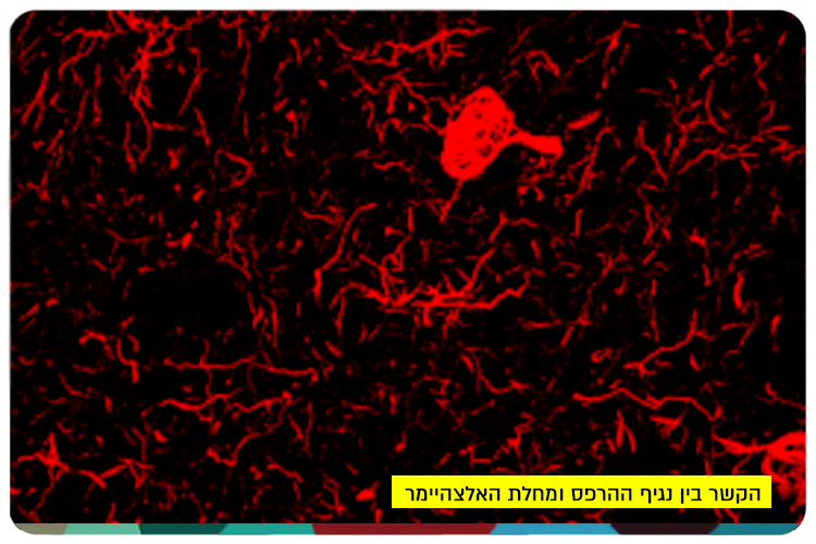 הקשר בין נגיף ההרפס ומחלת האלצהיימר The link between the Herpes virus and Alzheimers