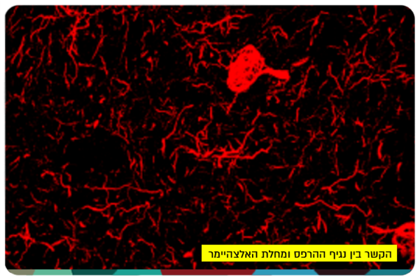 הקשר בין נגיף ההרפס ומחלת האלצהיימר The link between the Herpes virus and Alzheimers